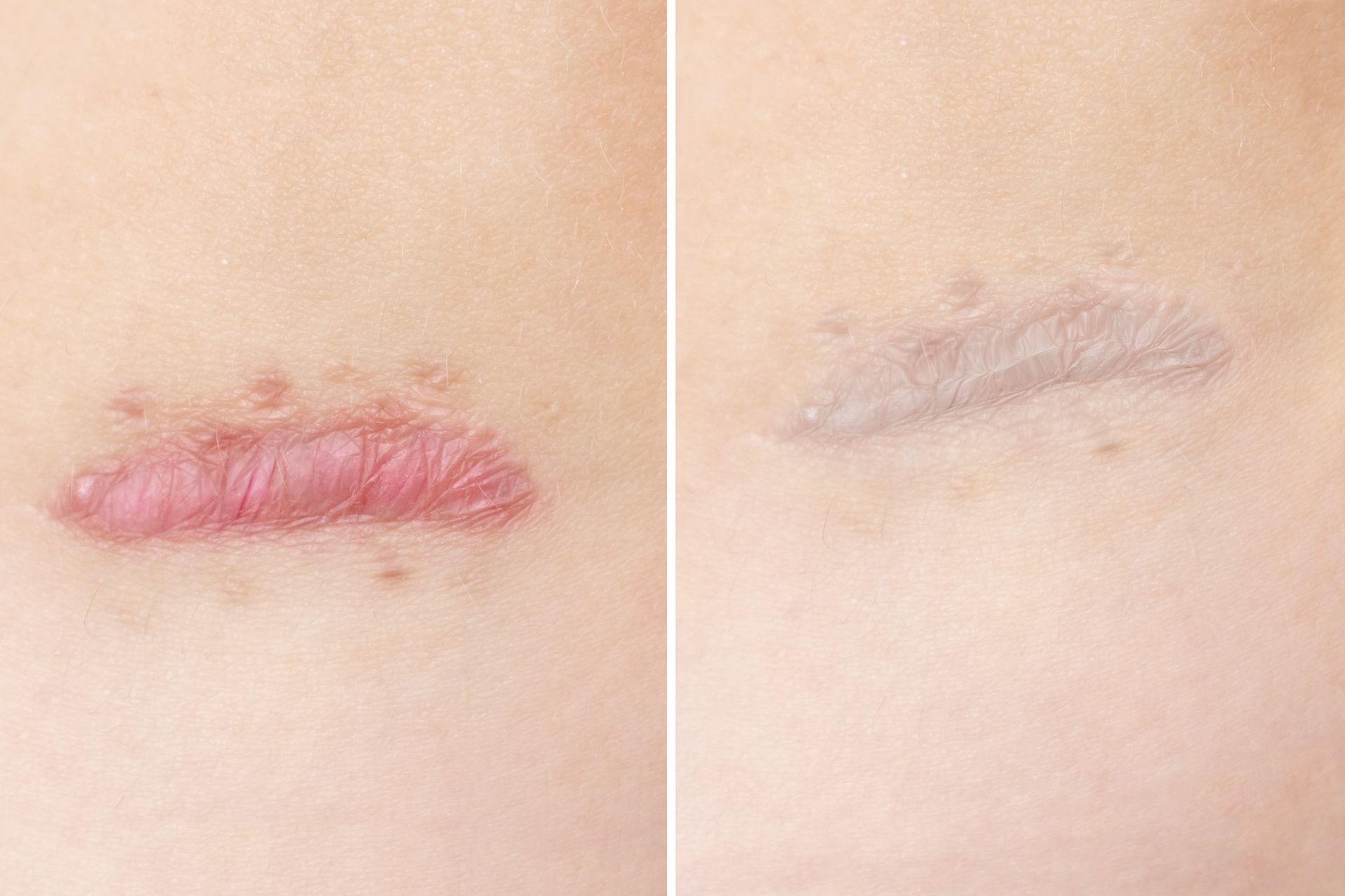 A before and after picture of a scar on a person 's skin.