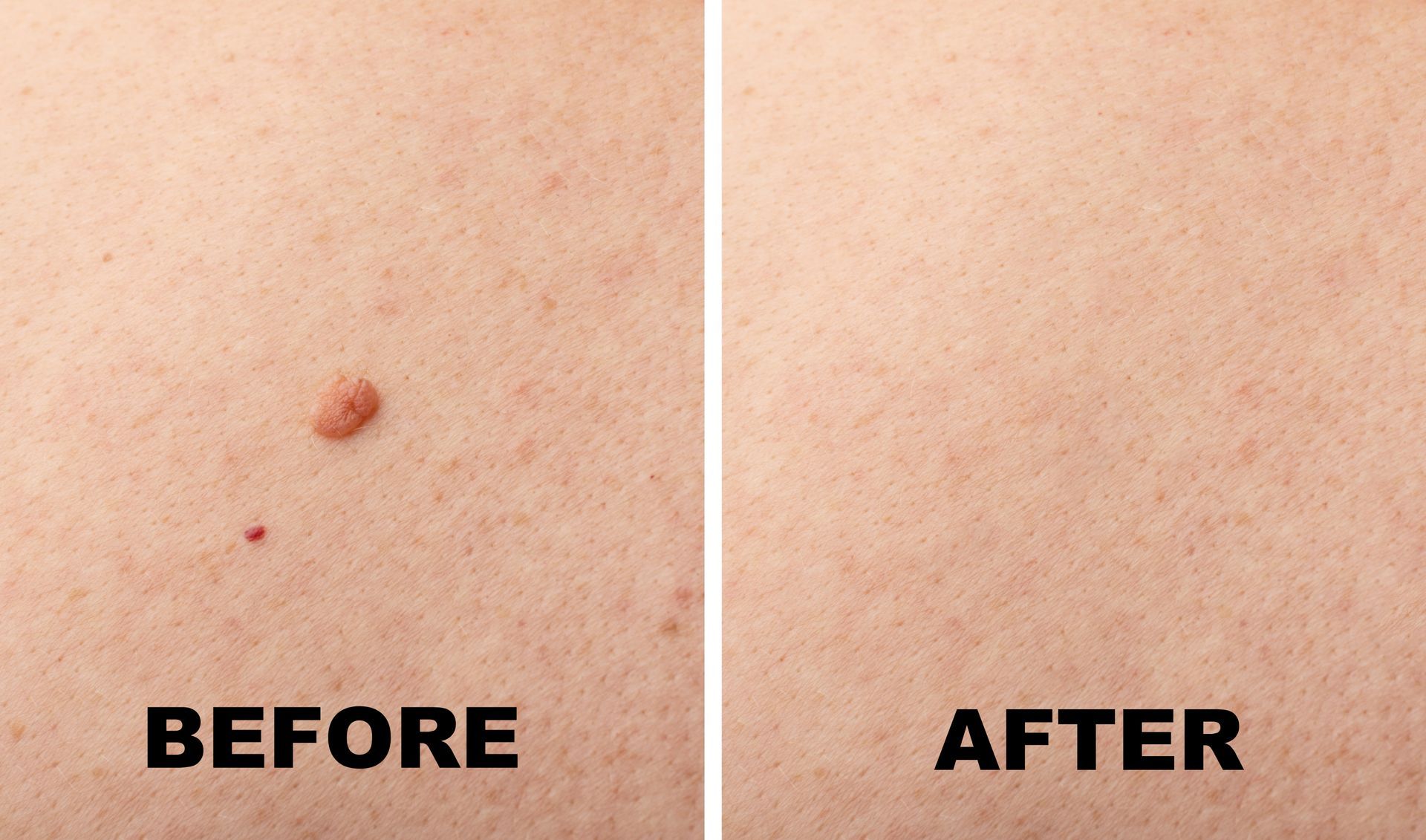 A before and after picture of a mole on a person 's back.