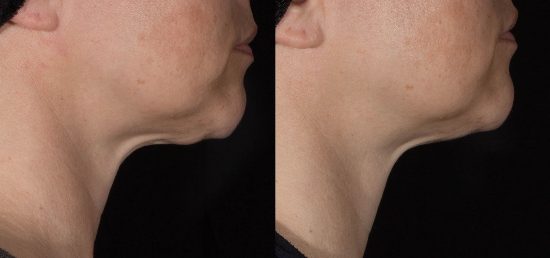 A before and after photo of a woman 's neck and face.