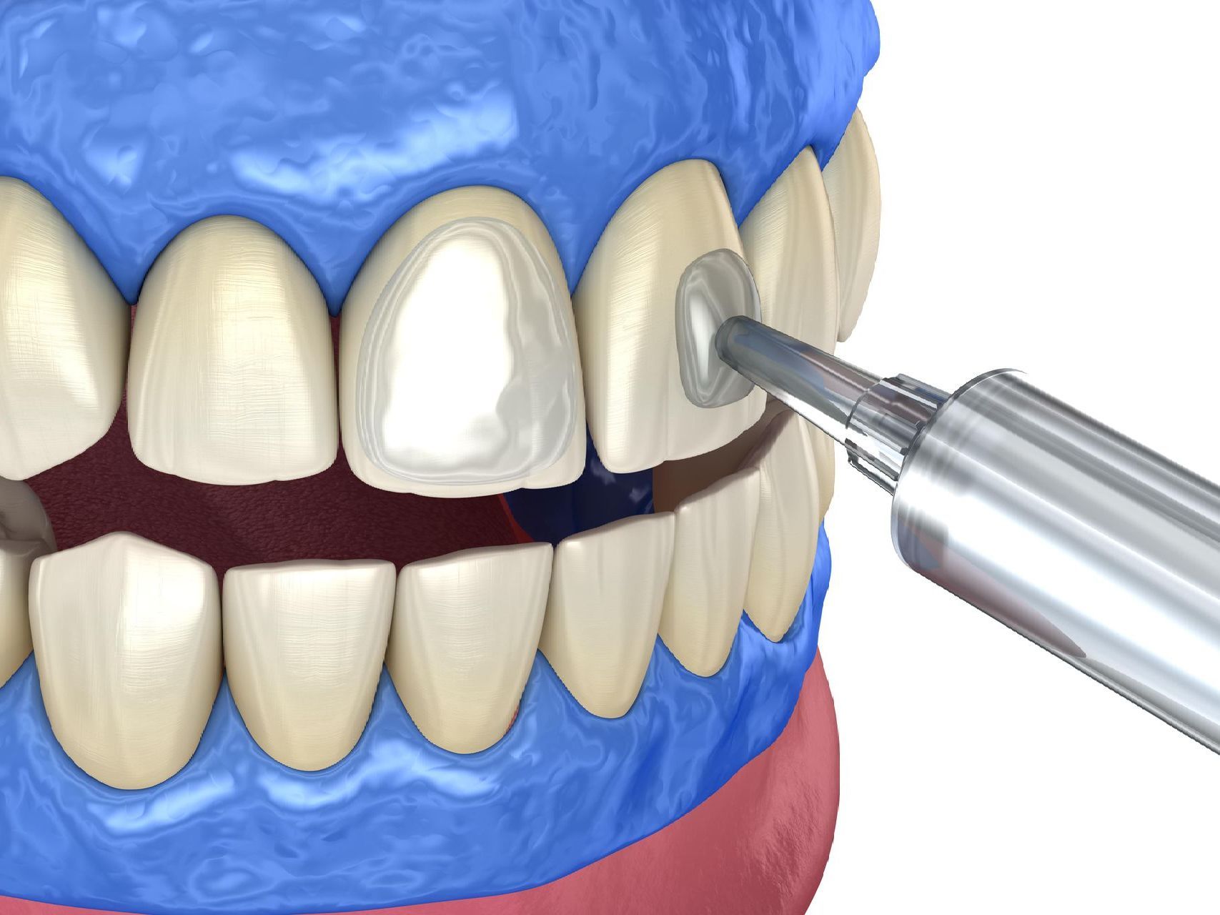 A close up of a person 's teeth with whitening gel on them