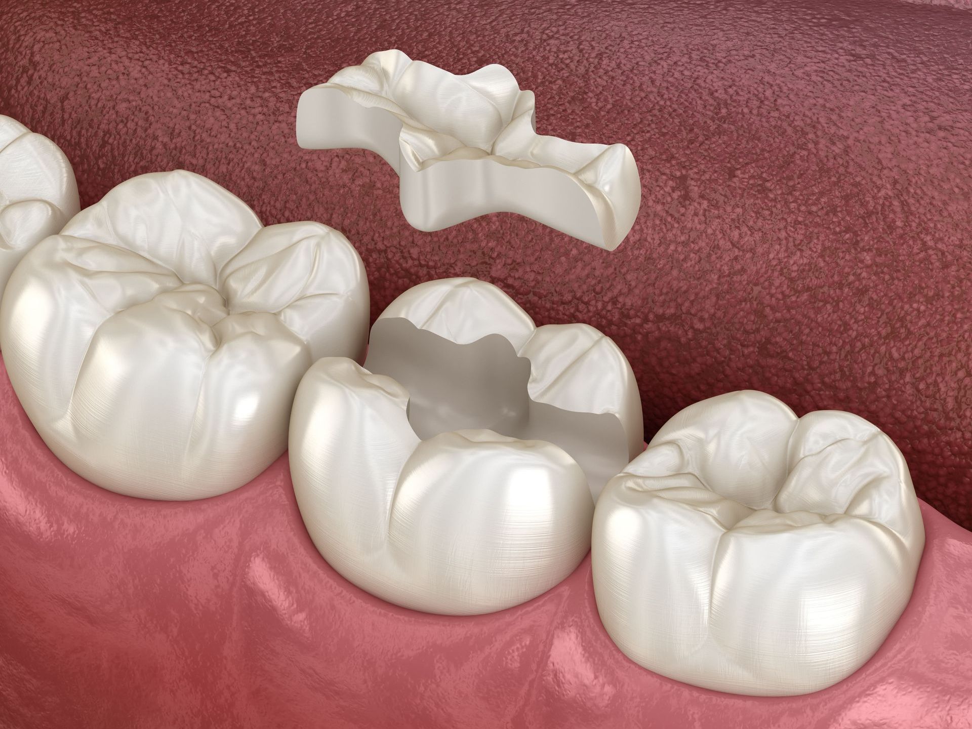 A computer generated image of a tooth with a filling in it