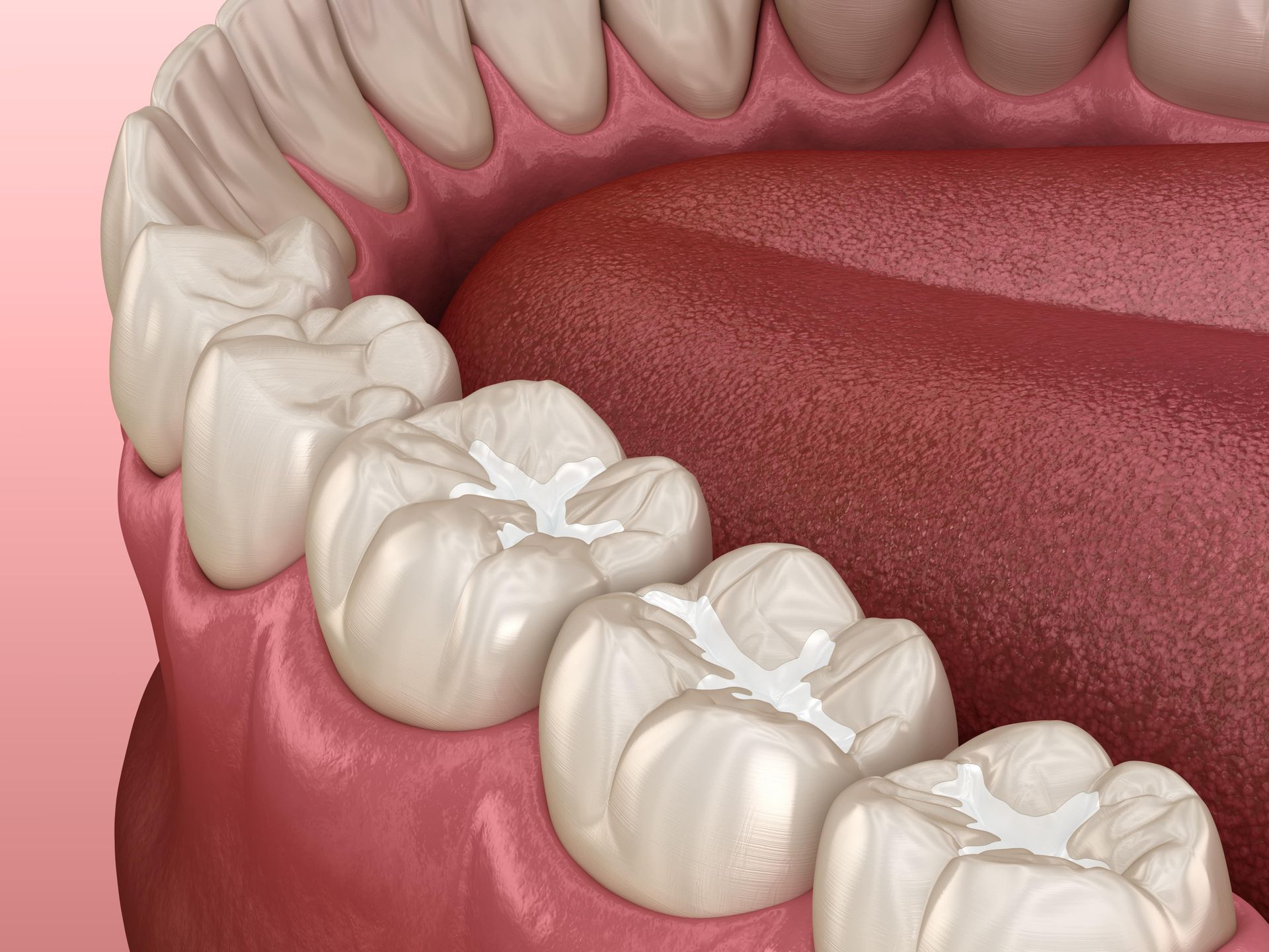 A close up of a tooth with sealants in it