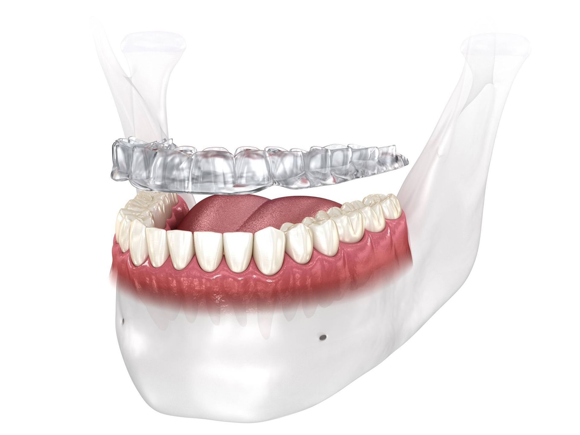 A computer generated image of a person s mouth with an oral device on their teeth