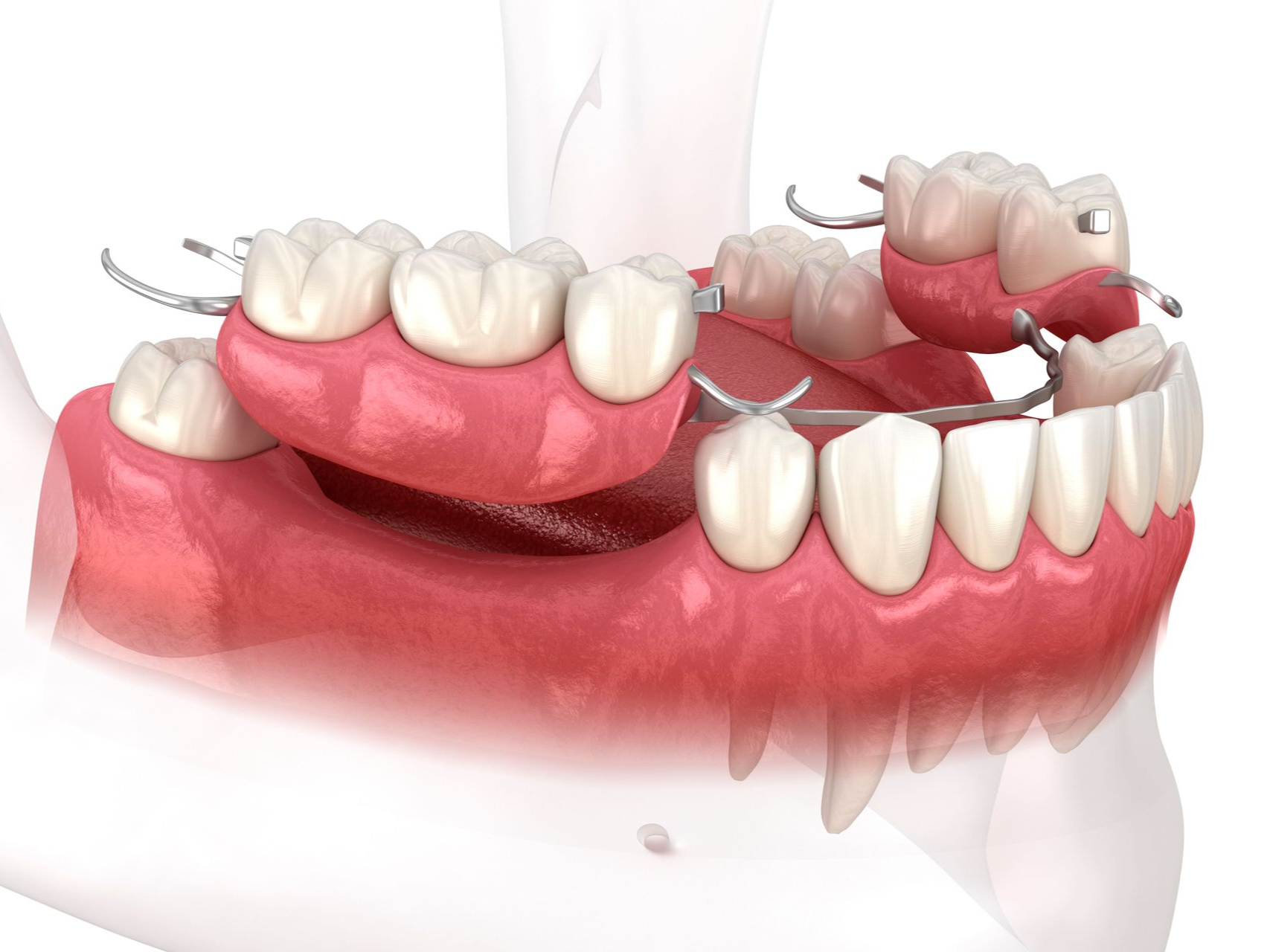 3D illustration of a mouth with upper and lower dentures and dental prosthetic devices