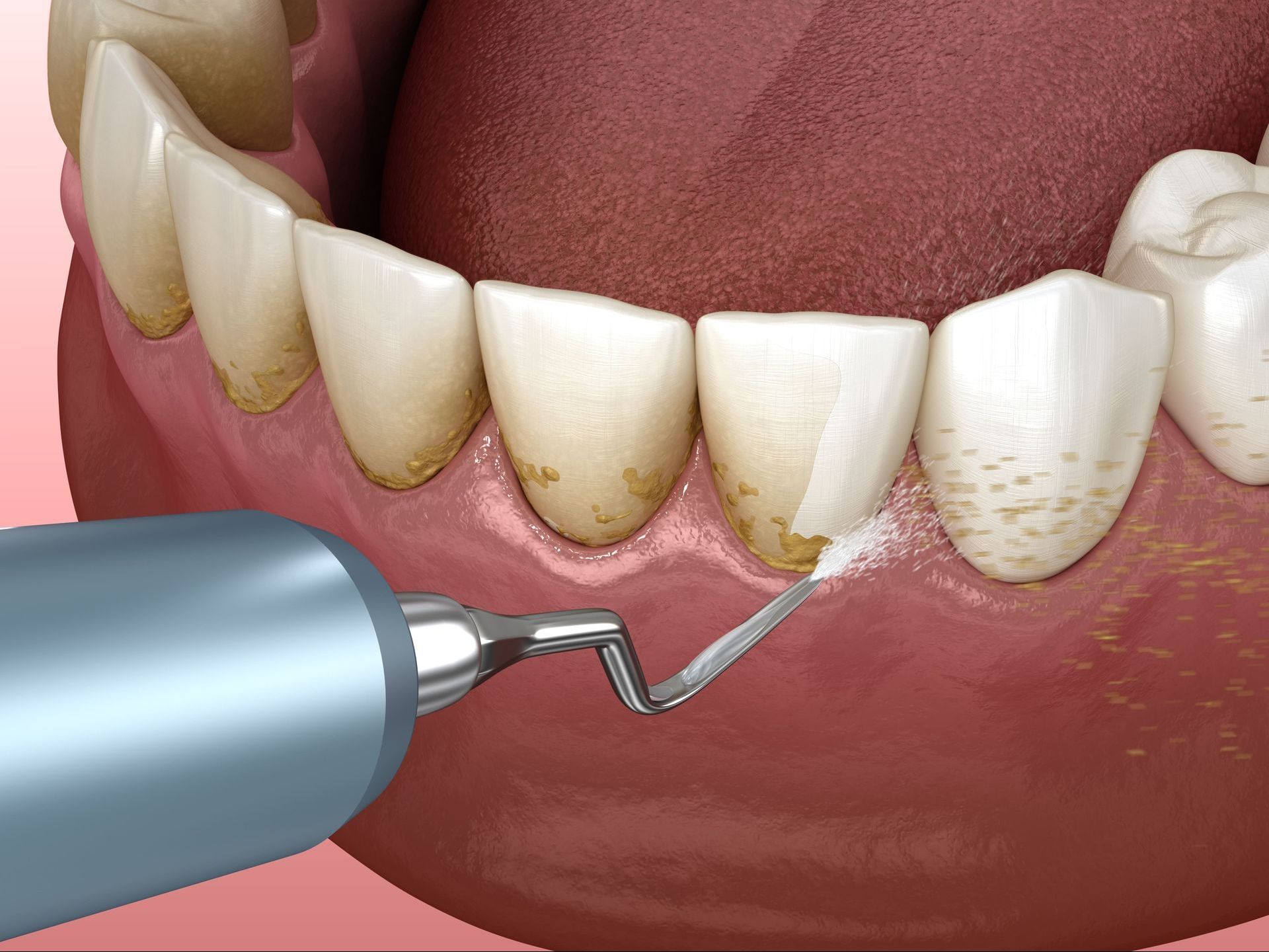 A close up of a person's teeth being cleaned with high powered water