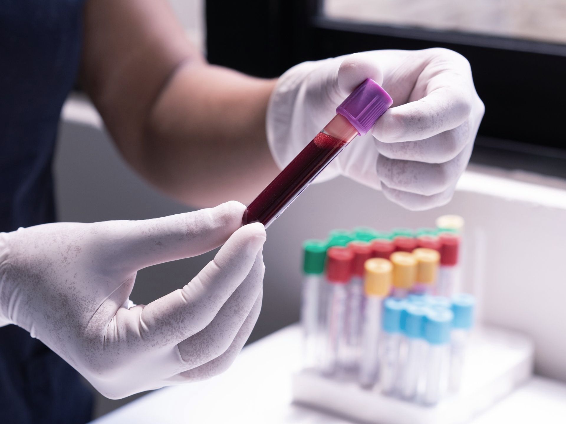 Blood in Collection Tube Blood in Collection Tube