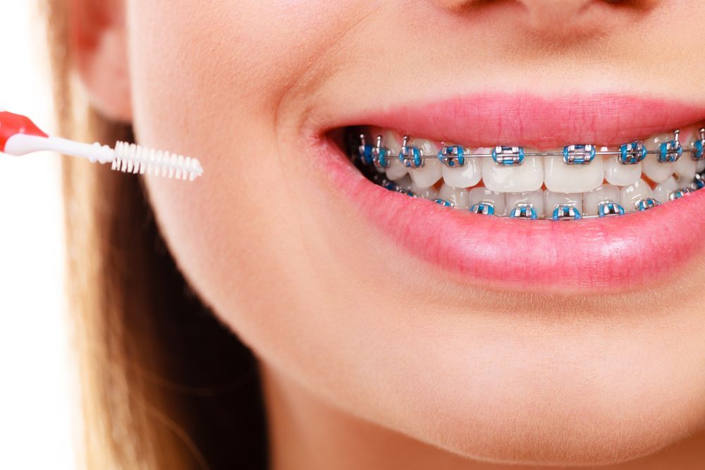 A Woman With Braces is Brushing Her Teeth With an Interdental Brush — Dubbo Dental in Dubbo, NSW