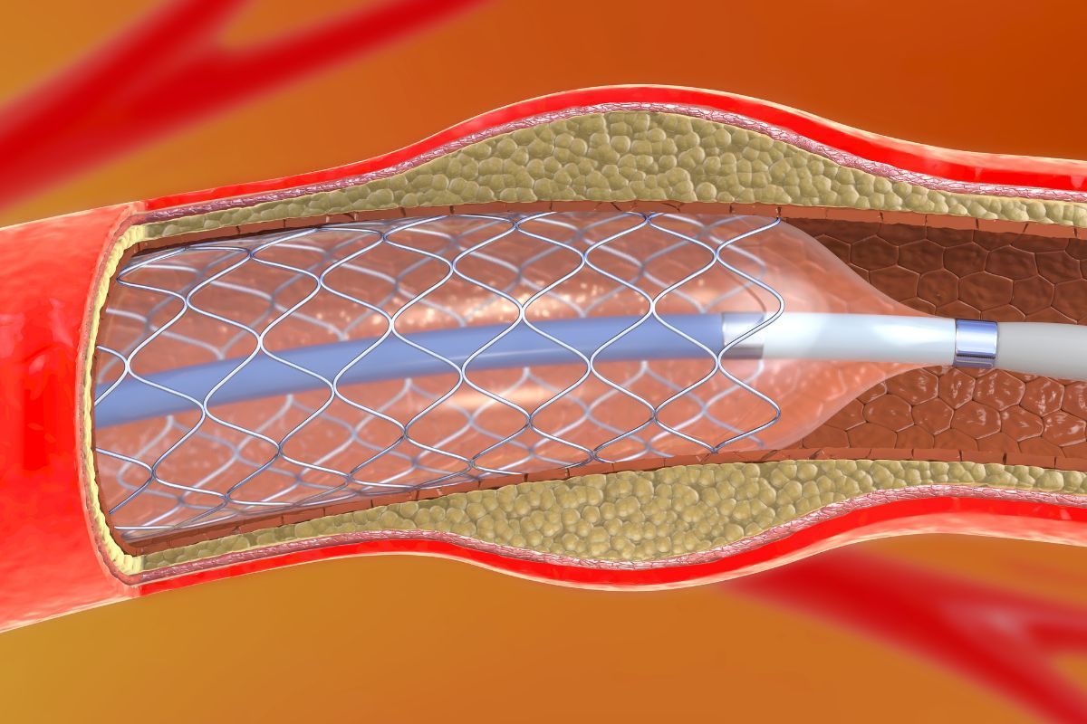 angioplastia-clinica-vascullare-cirurgia-vascular-foz-do-iguacu