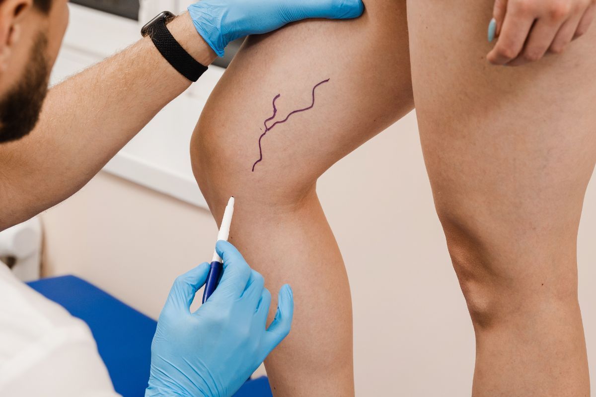 Cirurgia de varizes em Foz do Iguaçu: recupere sua qualidade de vida com segurança