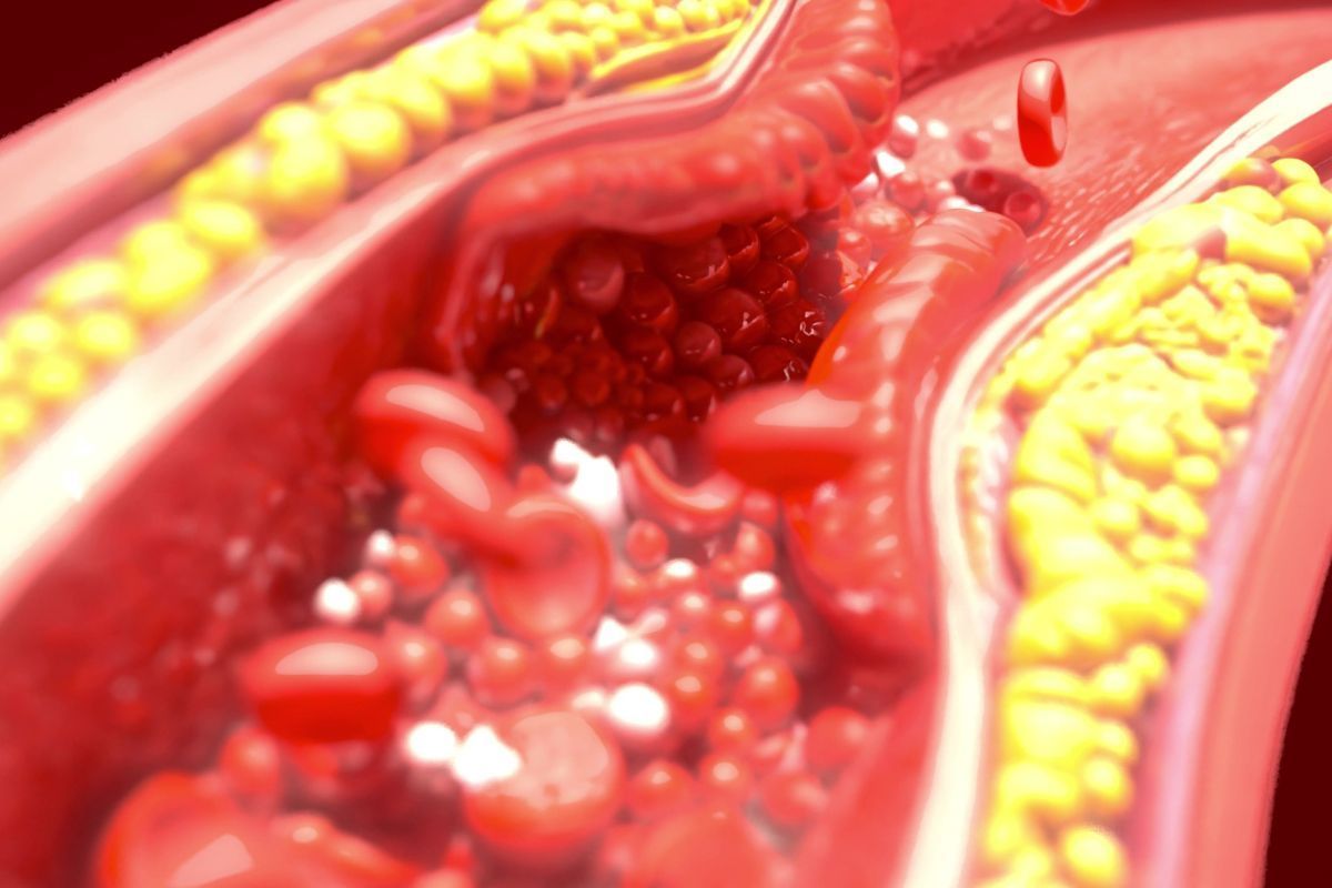 Embolia arterial: o que é e por que exige atendimento imediato?