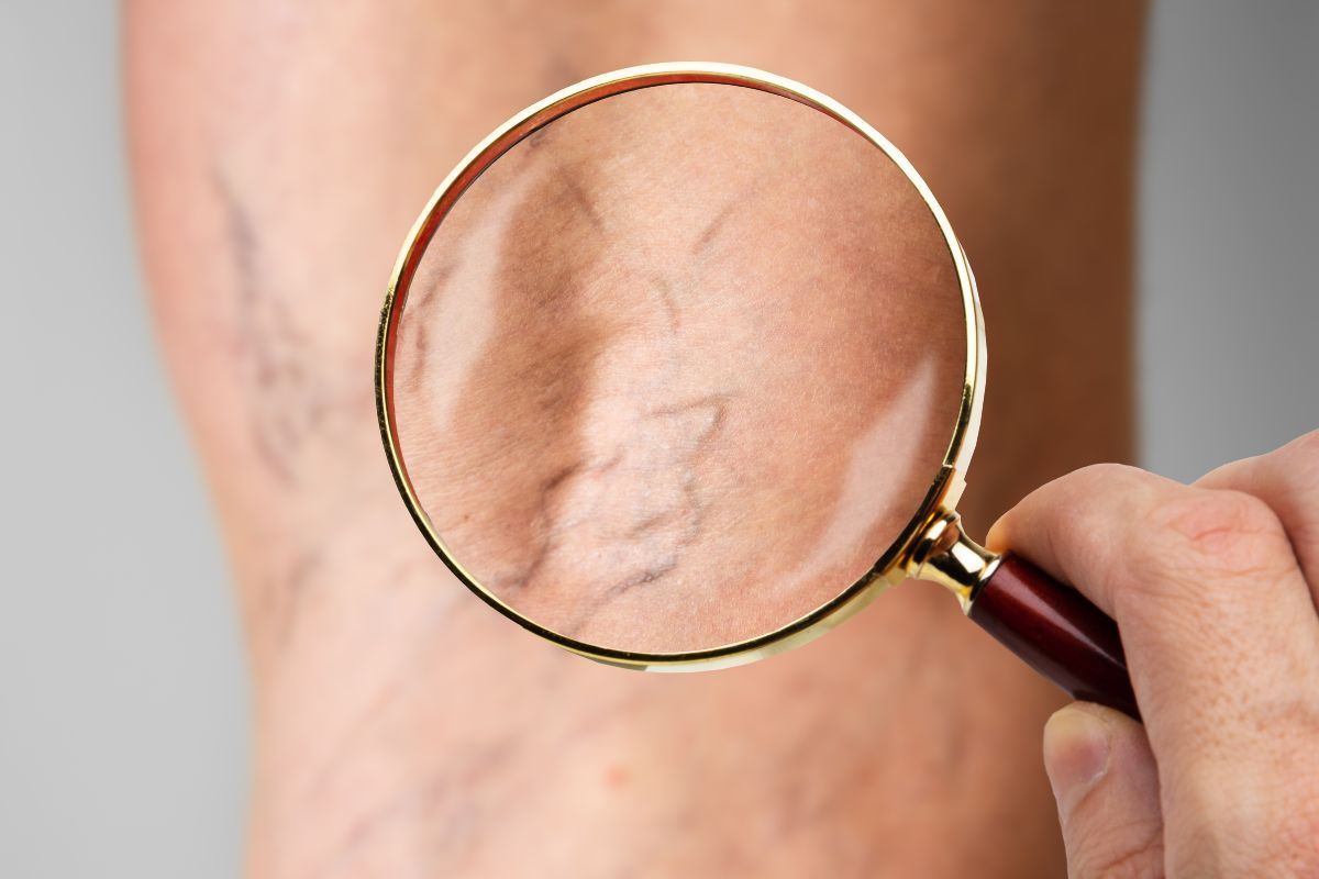 flebite-clinica-vascullare-cirurgia-vascular-foz-do-iguacu
