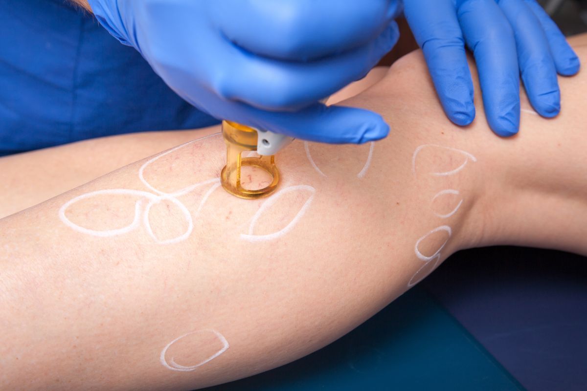 laser-tratar-varizes-vasinhos-vascular-foz-do-iguacu