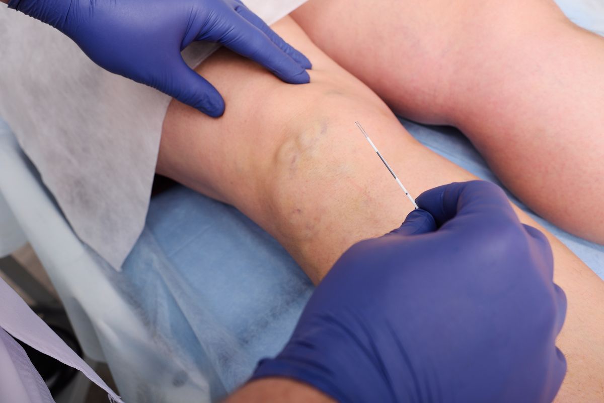 laser-varizes-clinica-vascullare-cirurgiao-vascular-foz-iguacu