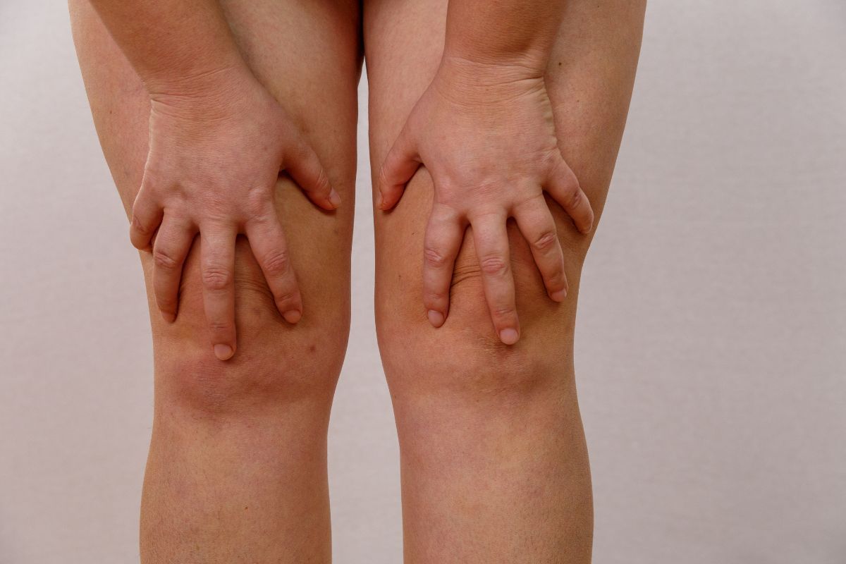 Linfedema nas pernas: o que é e como prevenir