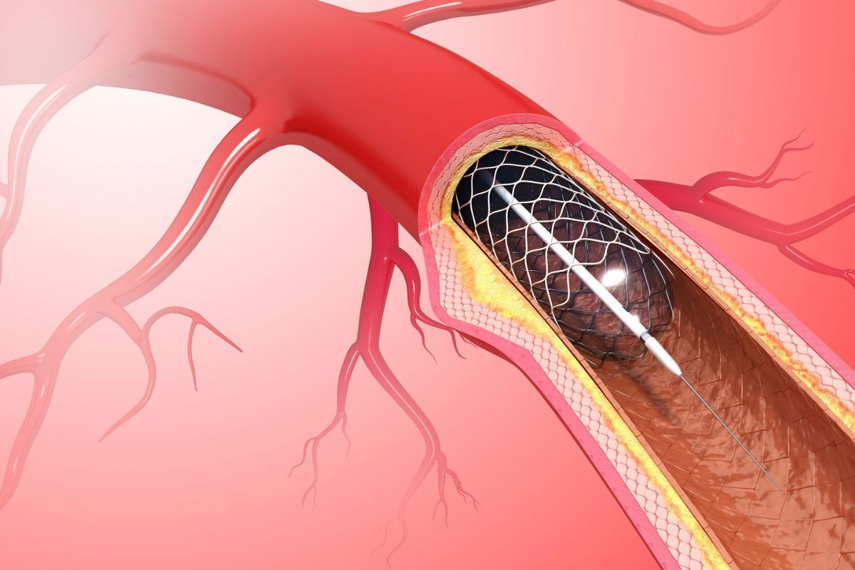 Stent em Foz do Iguaçu: entenda como funciona o procedimento