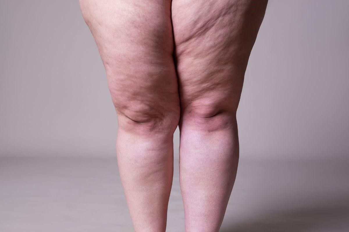 tratamento-lipedema-vascullare-cirurgia-vascular-foz-do-iguacu