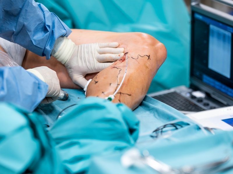 tratamento-raizes-das-varizes-clinica-vascullare-foz-do-iguacu