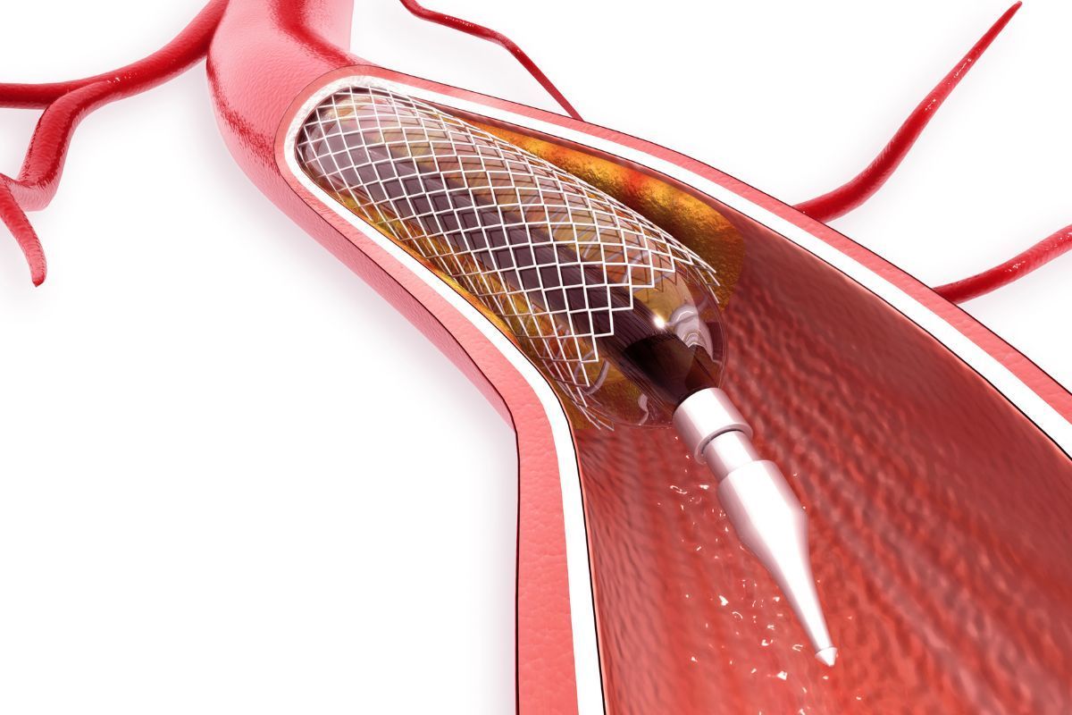 tratamento-veia-entupida-cirurgia-vascular-Vascullare-foz-do-iguacu