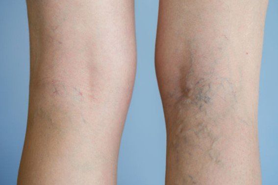 varizes-pequenas-clinica-vascullare-foz-medico-vascular-foz-iguacu