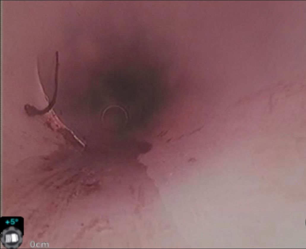 A close up of a person 's stomach with a needle sticking out of it.