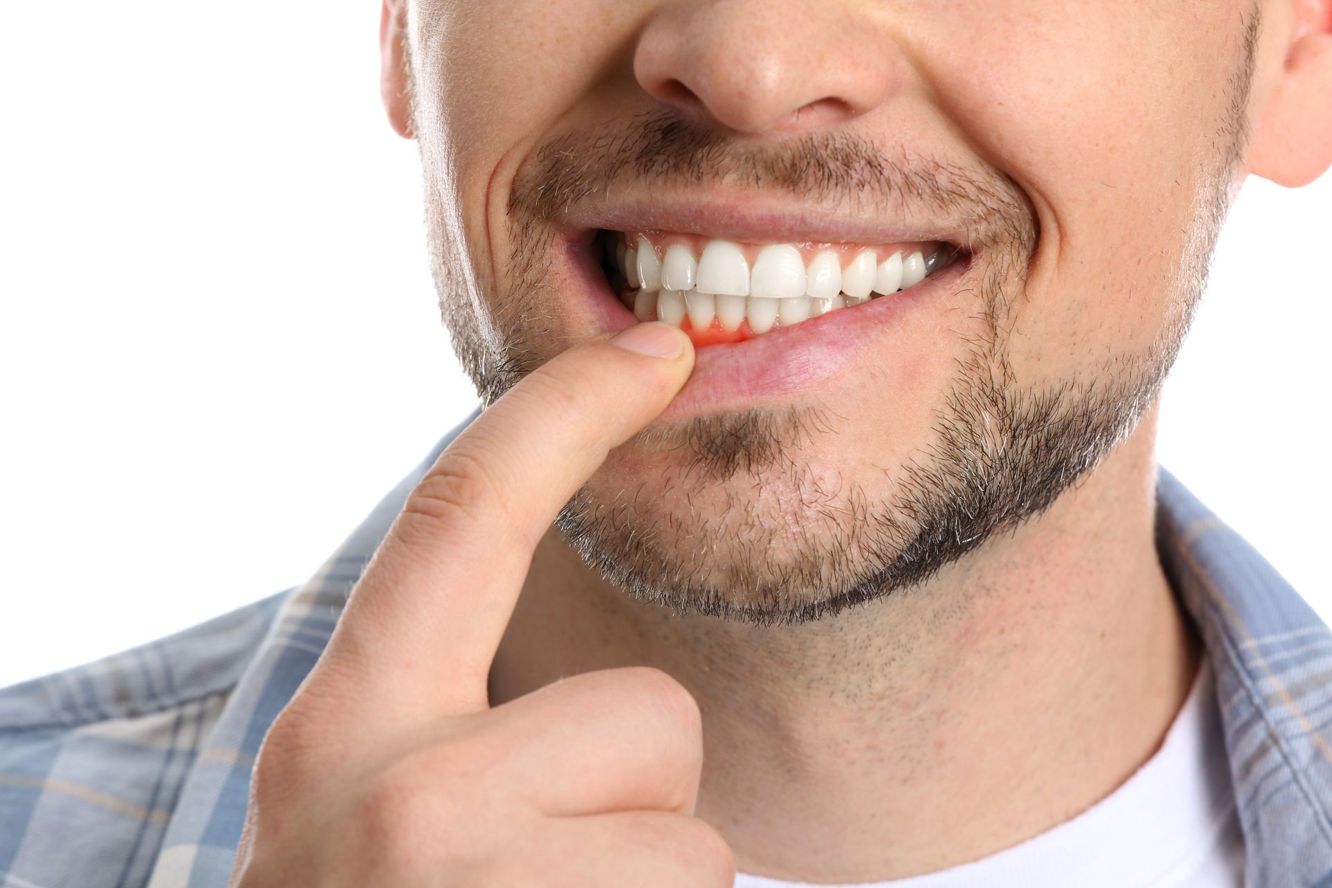 Man smiling, pointing at inflamed gum.
