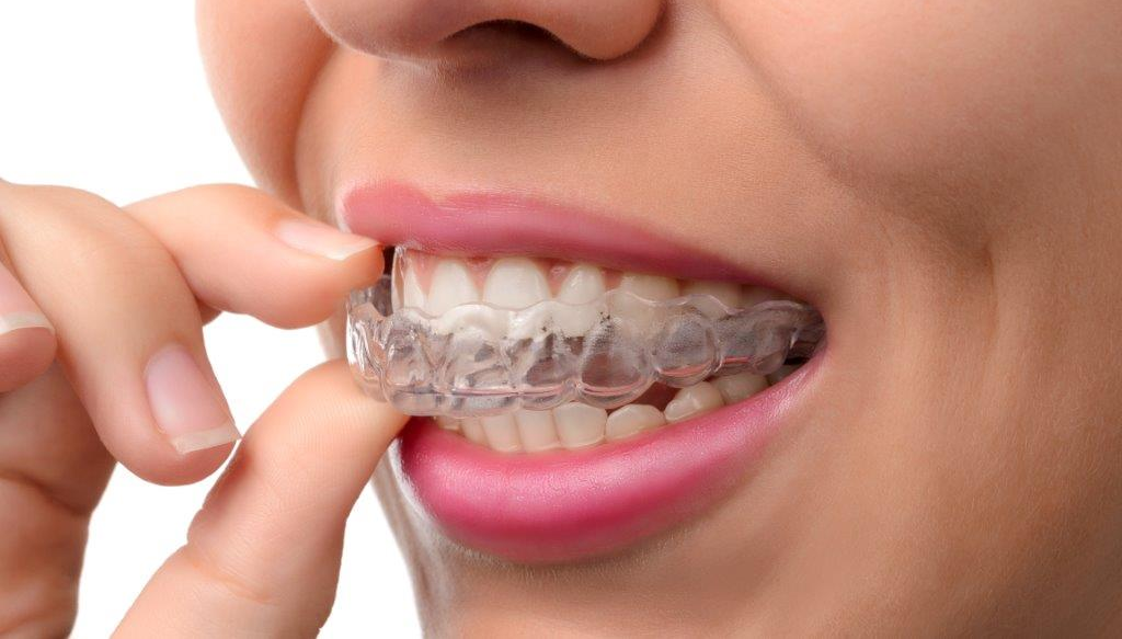 Woman Placing Invisalign Braces Over Her Teeth