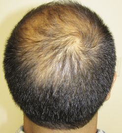 Stop and Regrow australia client review - Jeff age 44 before