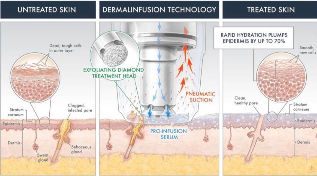 dermal infusion process