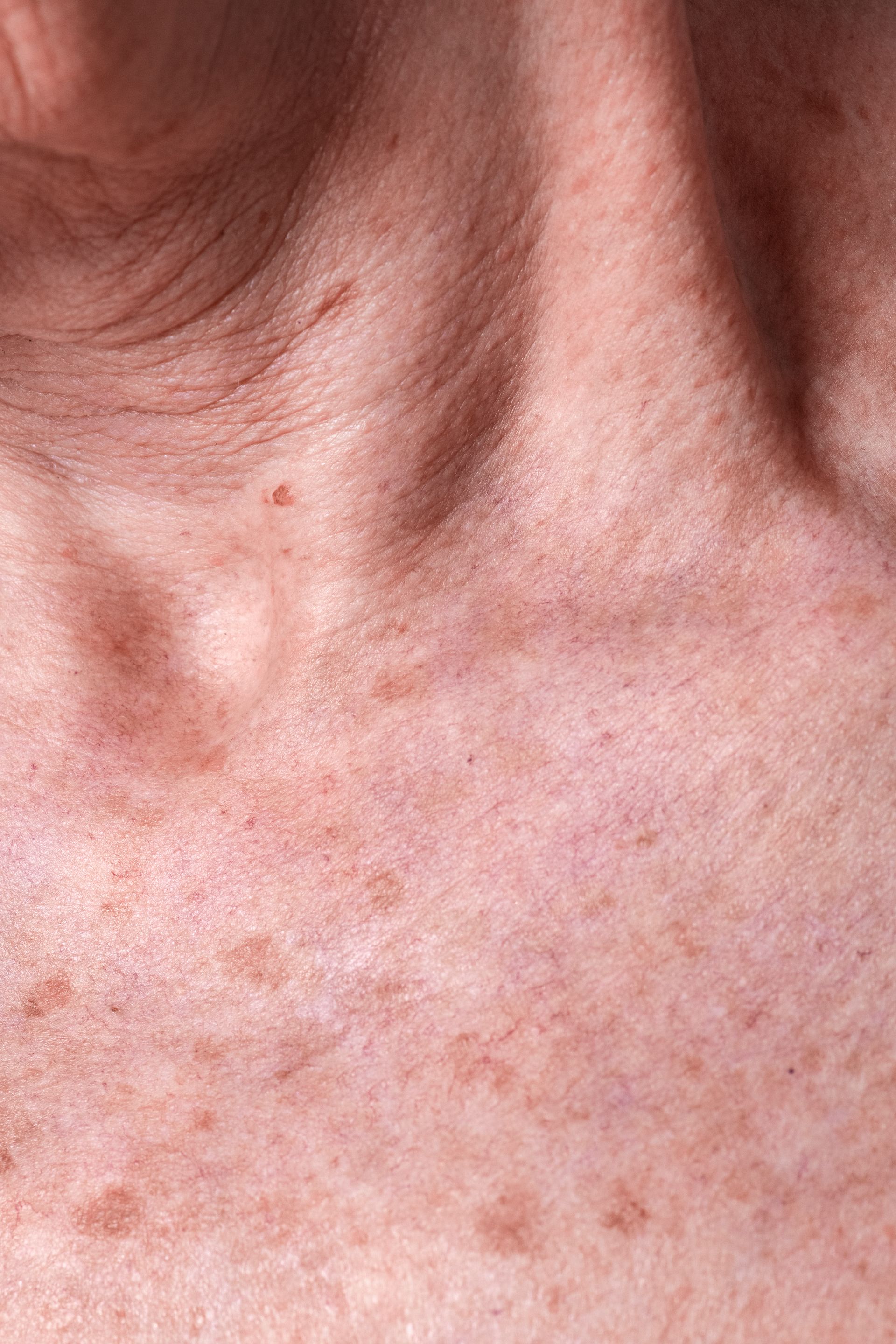 woman with age spots
