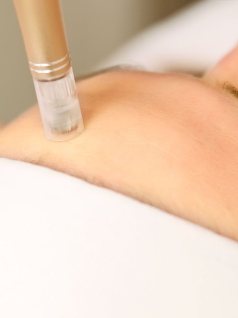 microneedling procedure