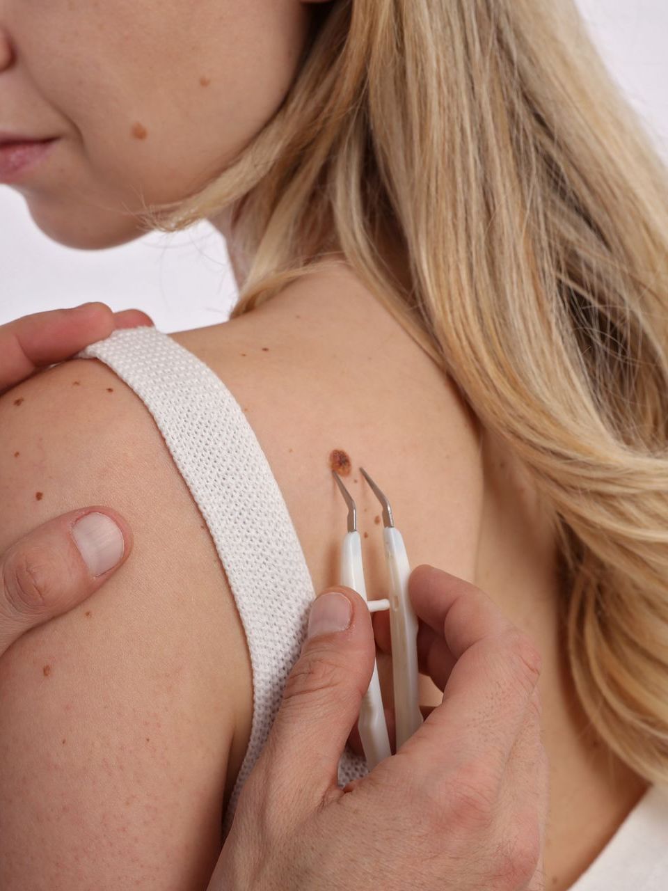 skin tag removal