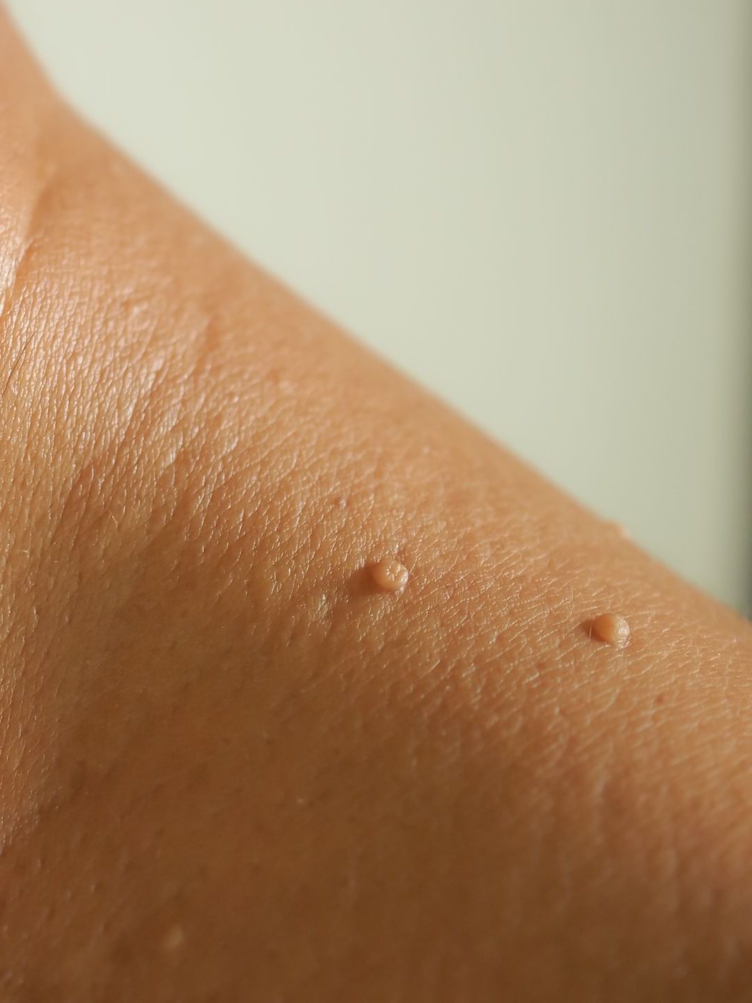 skin tag on neck