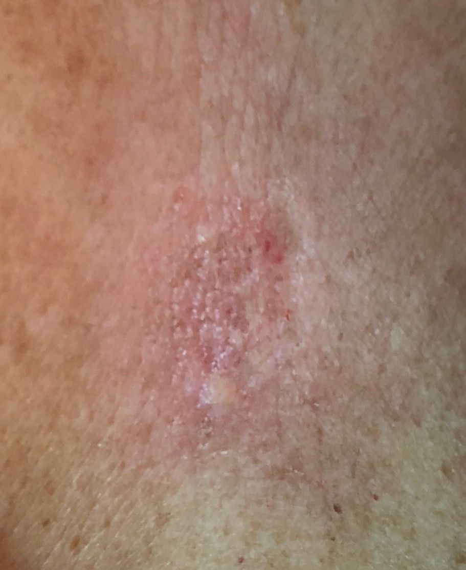 after scar
