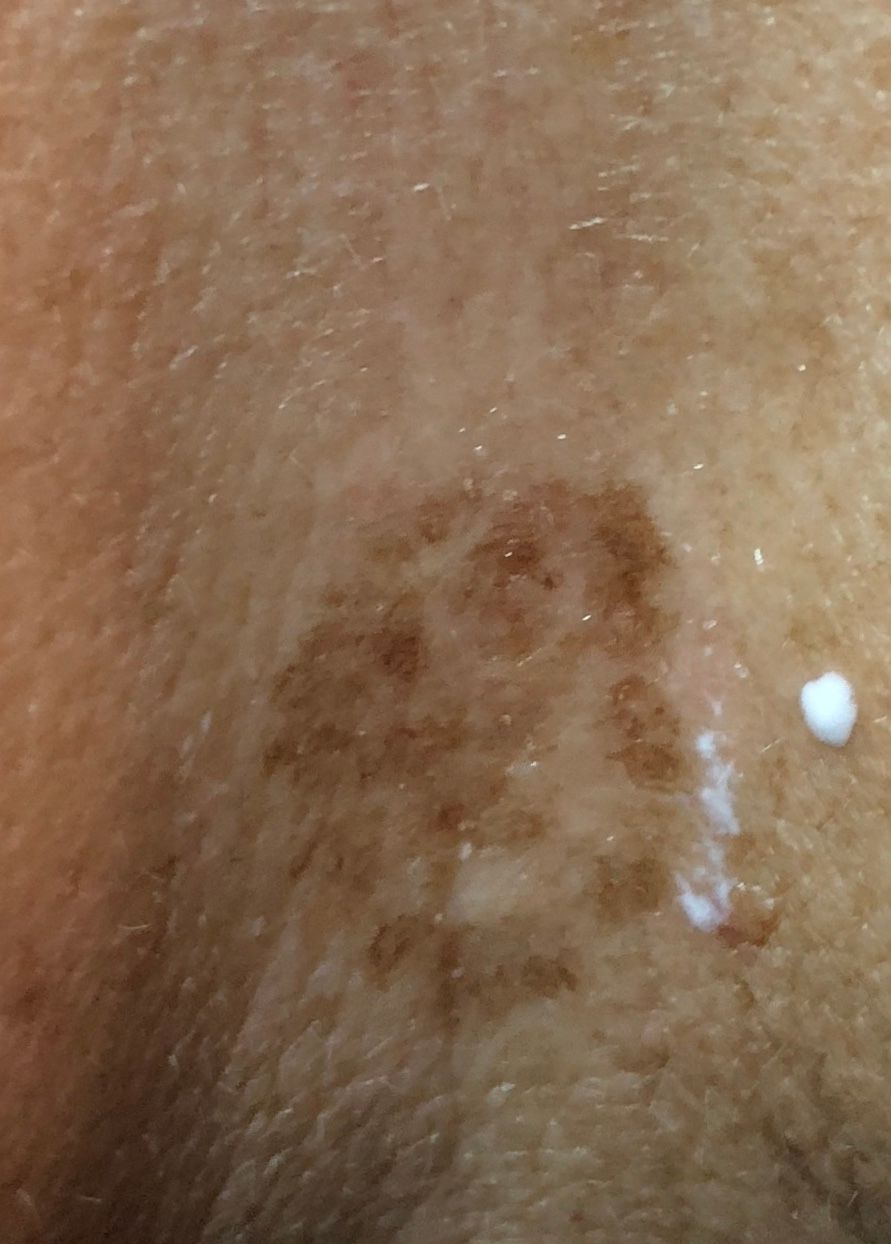 Before scar