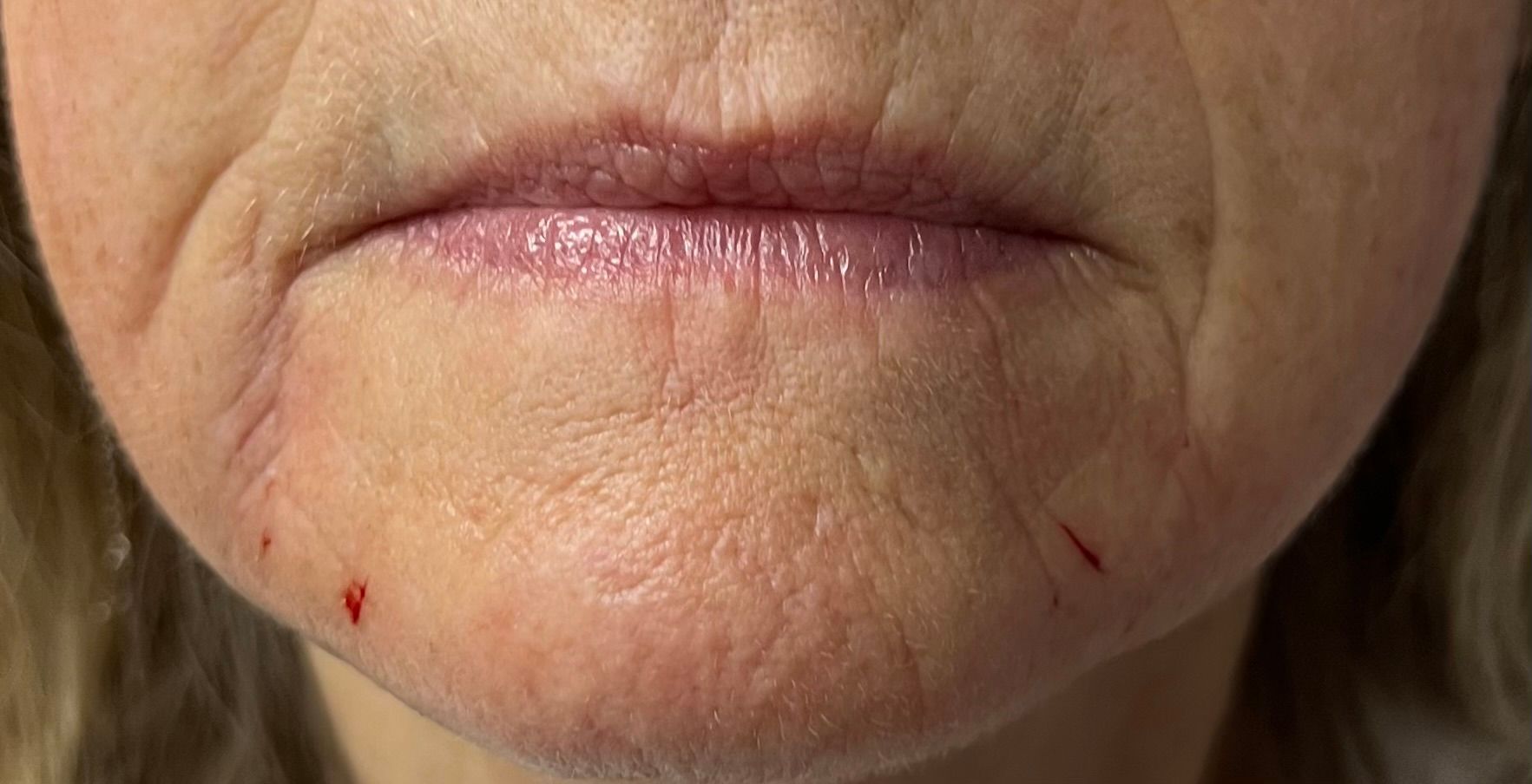 after filler