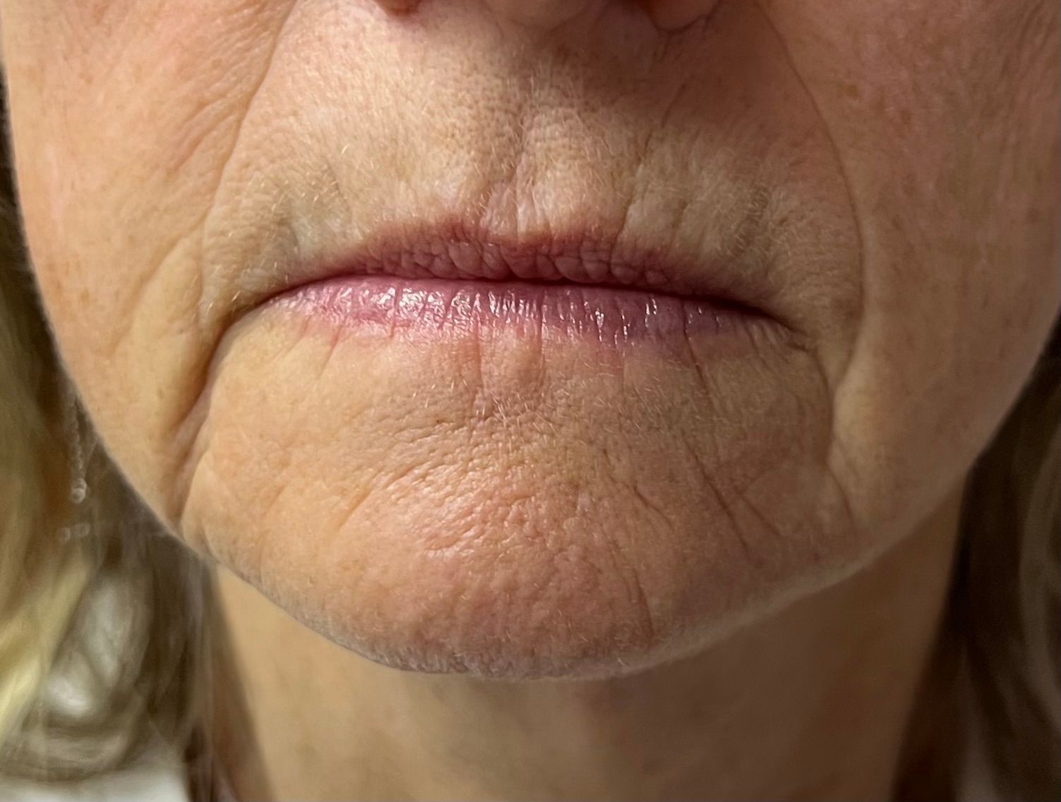  before filler