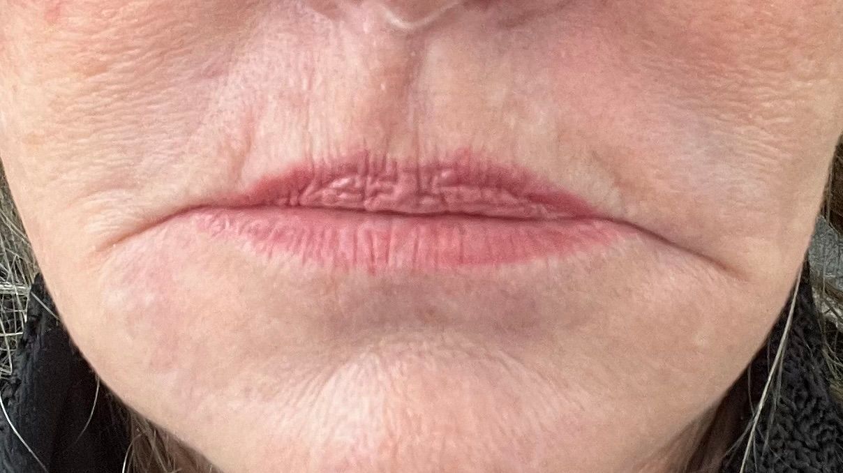 Before filler