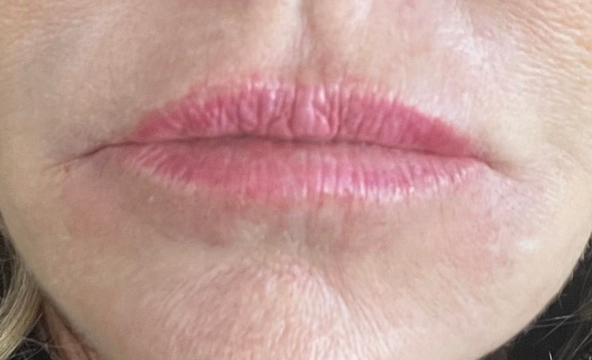 after filler