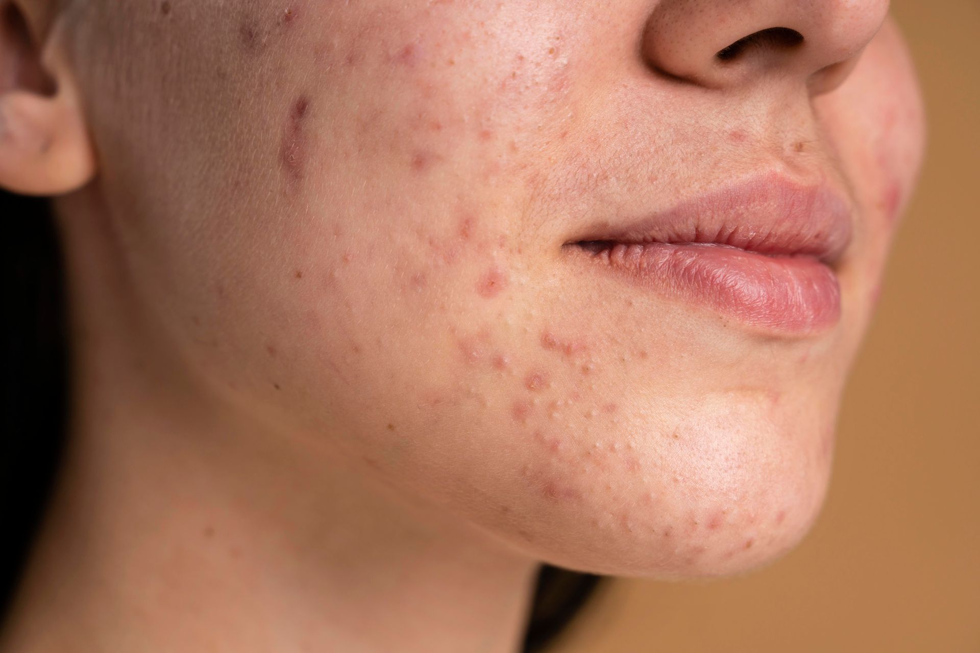 Close-up of a person's face showing skin affected by acne with multiple pimples and scars.