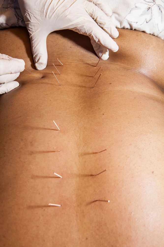 Gloved hands inserting acupuncture needles into a person’s bare back
