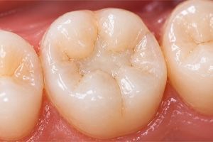 Close-up of a molar with a small cavity on the chewing surface, surrounded by gums.