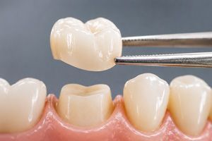 Dental crown held above a prepared tooth beside neighboring teeth and gums