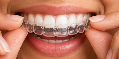 Close-up of teeth with clear dental aligner being held in place by fingers