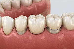 Close-up of lower teeth with dental crowns and visible metal at the gumline