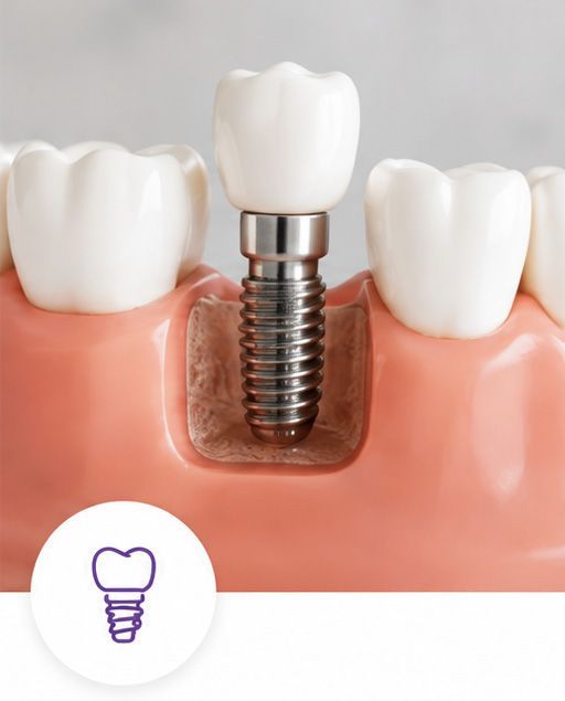 Tooth implant model showing a metal screw in pink gum with white crown teeth around it