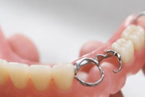 Close-up of lower dentures with a metal clasp bridge resting on fingers
