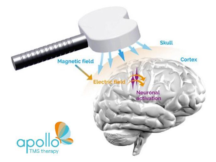 A diagram of a magnetic field being applied to a brain from Apollo TMS