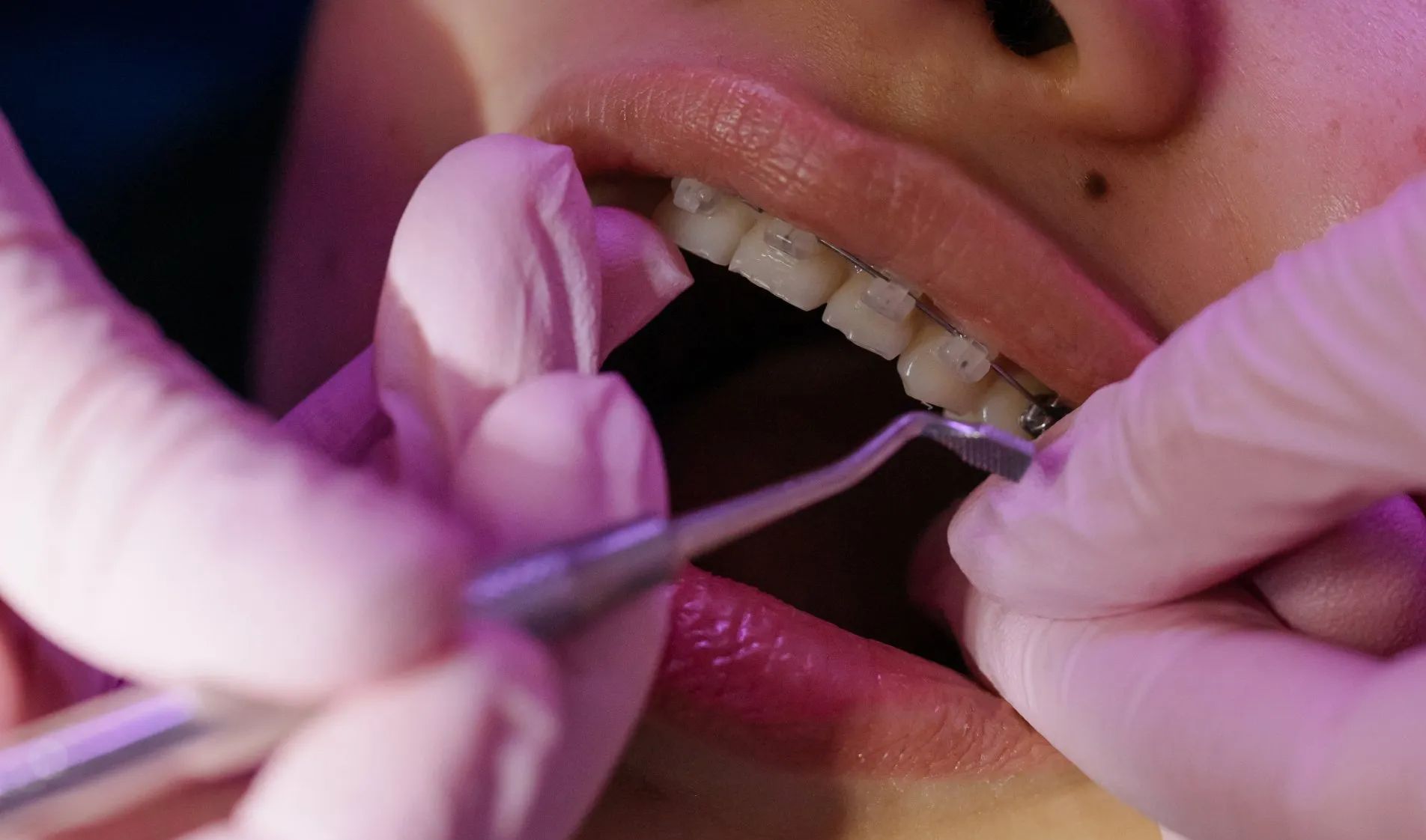 Hands in pink gloves adjusting braces on teeth.
