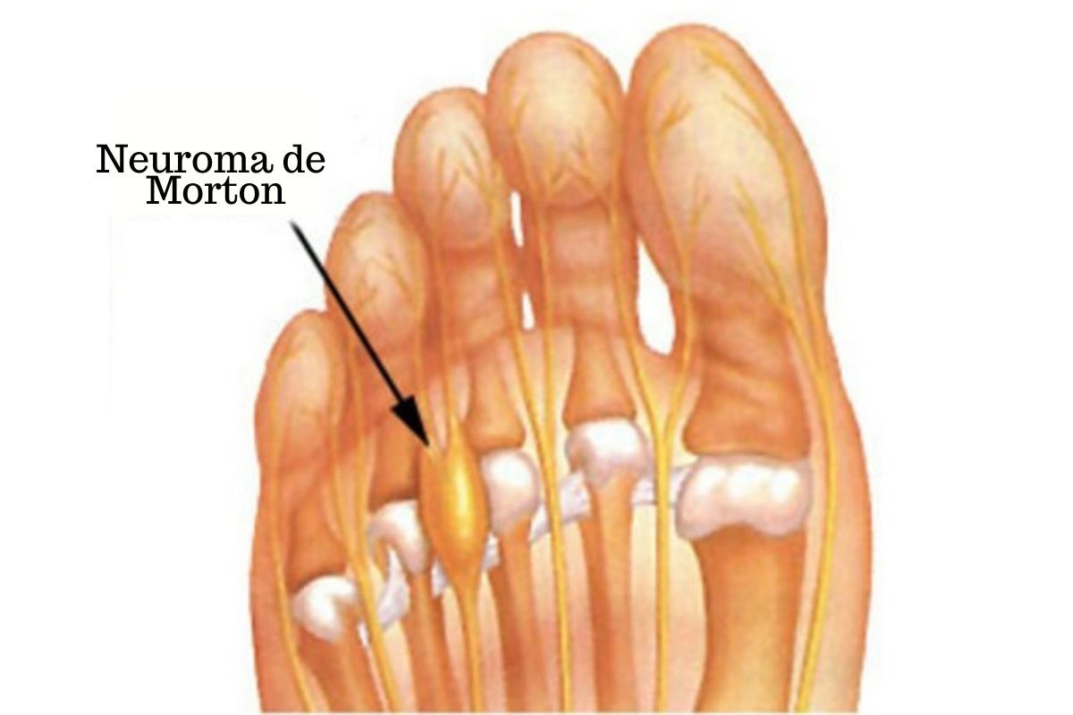 Neuroma de Morton: o que é e como tratar