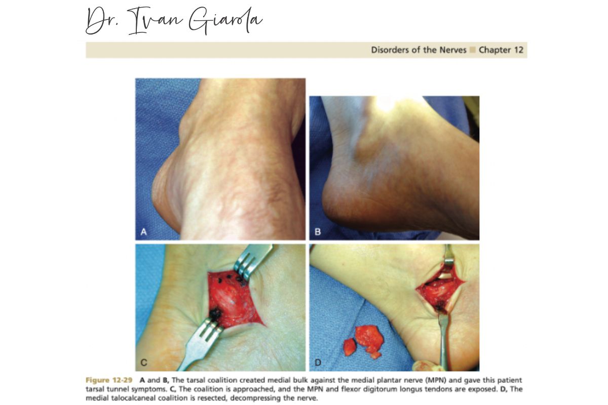 cirurgia-tarso-dr-ivan-giarola-ortopedista-tornozelo-sao-paulo